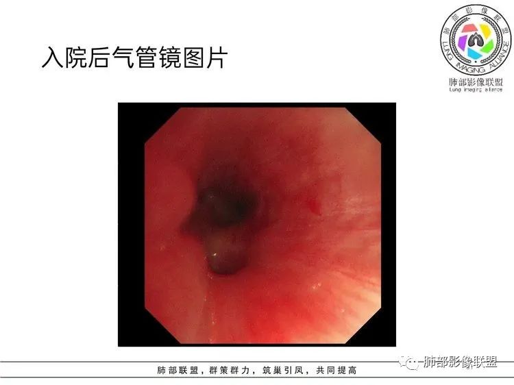 影像PPT - 【病例】难得一见的单发空洞型肺隐球菌感染-30 影像PPT - 【病例】难得一见的单发空洞型肺隐球菌感染-30