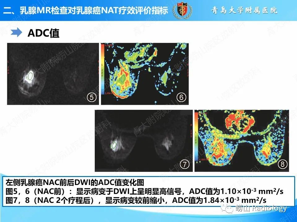 影像PPT - 【PPT】MRI评估乳腺癌新辅助治疗疗效-9