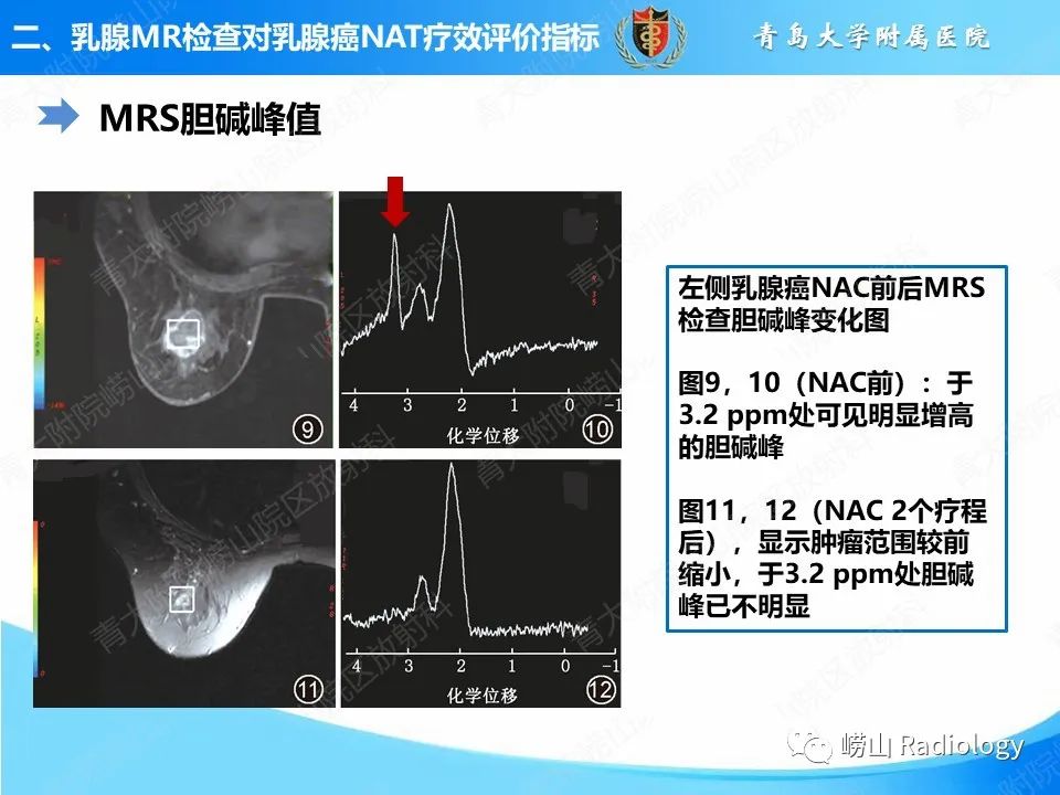 影像PPT - 【PPT】MRI评估乳腺癌新辅助治疗疗效-11