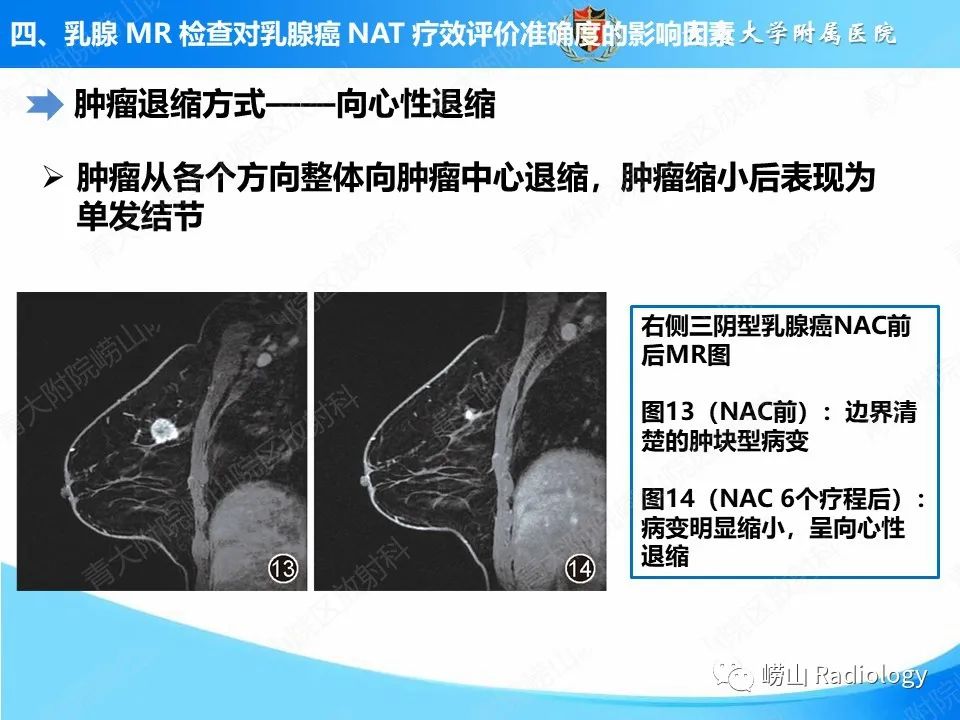 影像PPT - 【PPT】MRI评估乳腺癌新辅助治疗疗效-15