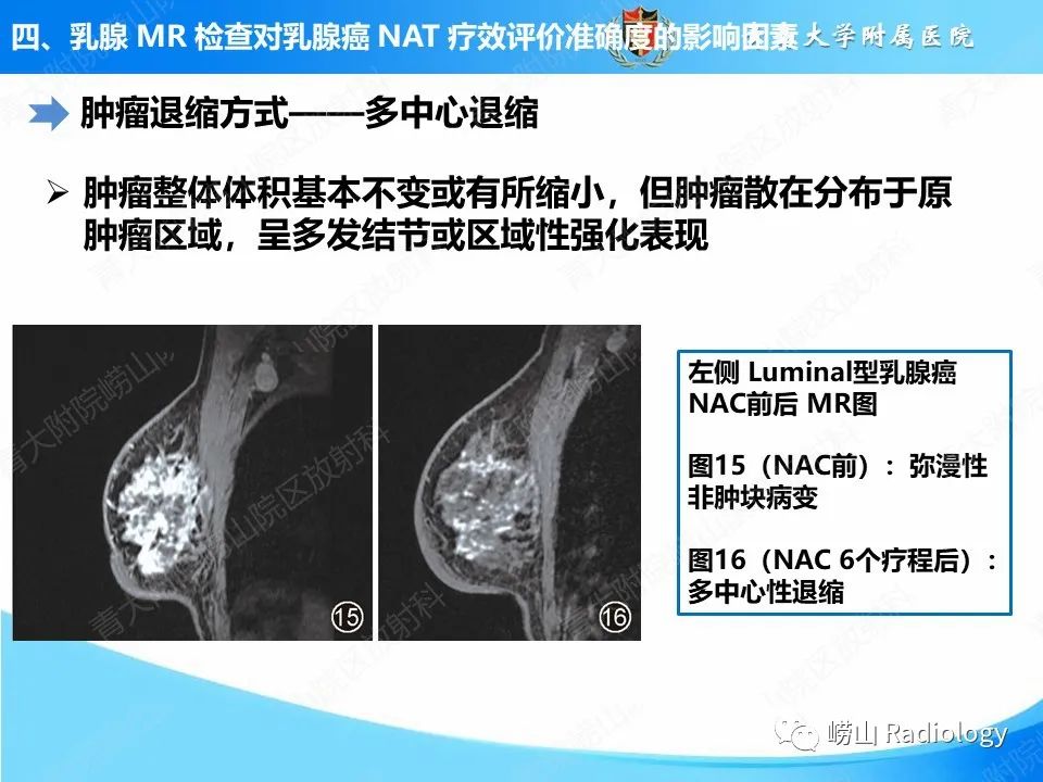 影像PPT - 【PPT】MRI评估乳腺癌新辅助治疗疗效-16