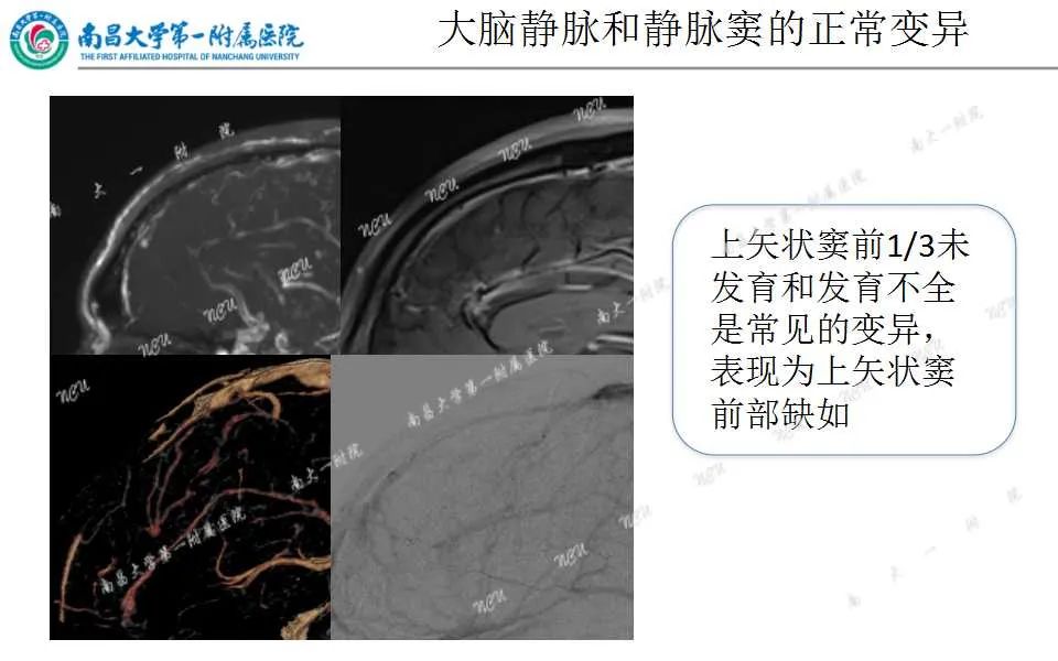 影像PPT - 【PPT】颅内静脉病变及相关卒中的影像学诊断-9