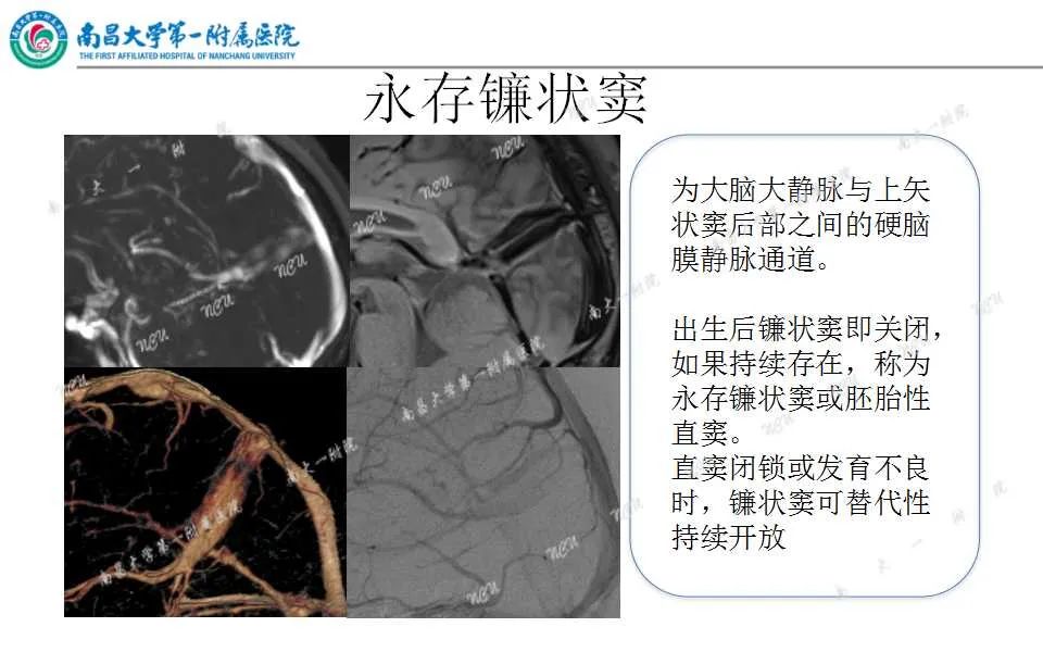 影像PPT - 【PPT】颅内静脉病变及相关卒中的影像学诊断-14