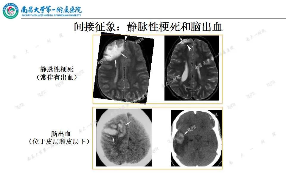 影像PPT - 【PPT】颅内静脉病变及相关卒中的影像学诊断-18