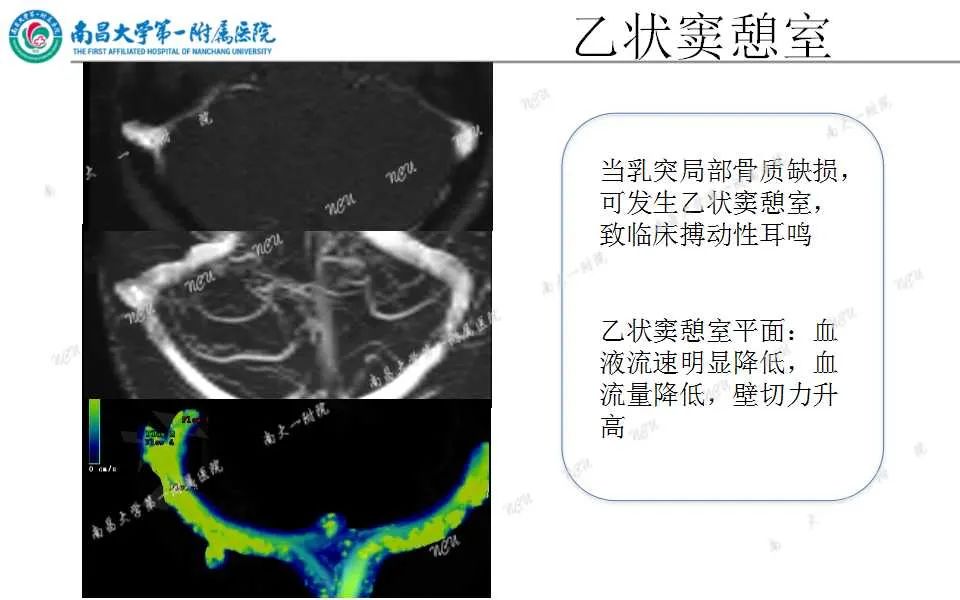 影像PPT - 【PPT】颅内静脉病变及相关卒中的影像学诊断-11