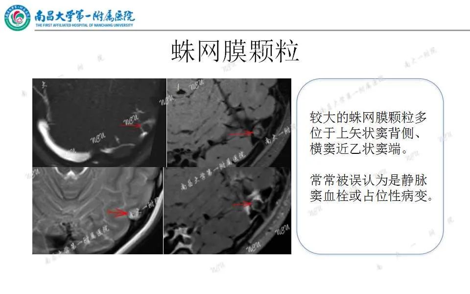 影像PPT - 【PPT】颅内静脉病变及相关卒中的影像学诊断-12