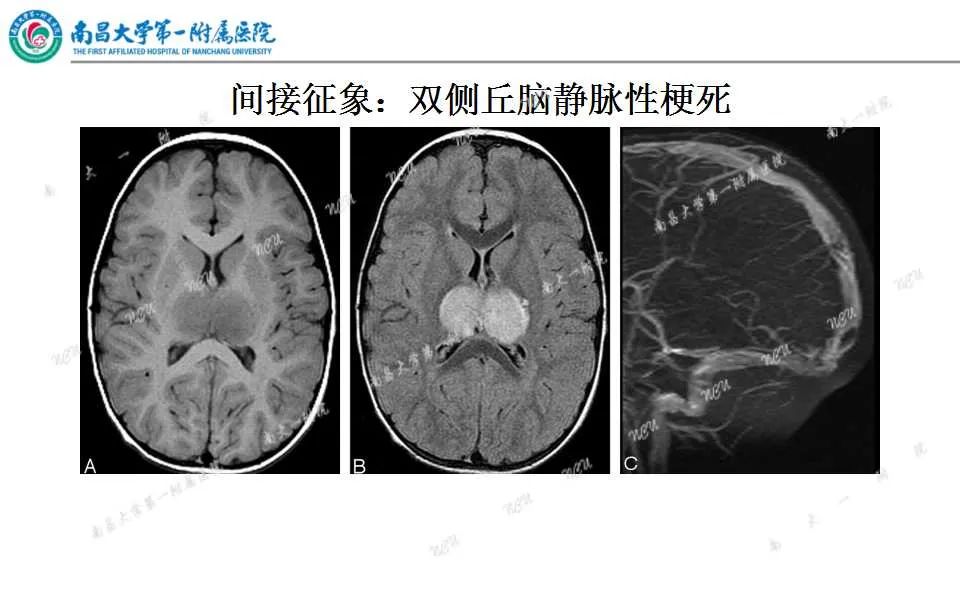 影像PPT - 【PPT】颅内静脉病变及相关卒中的影像学诊断-19