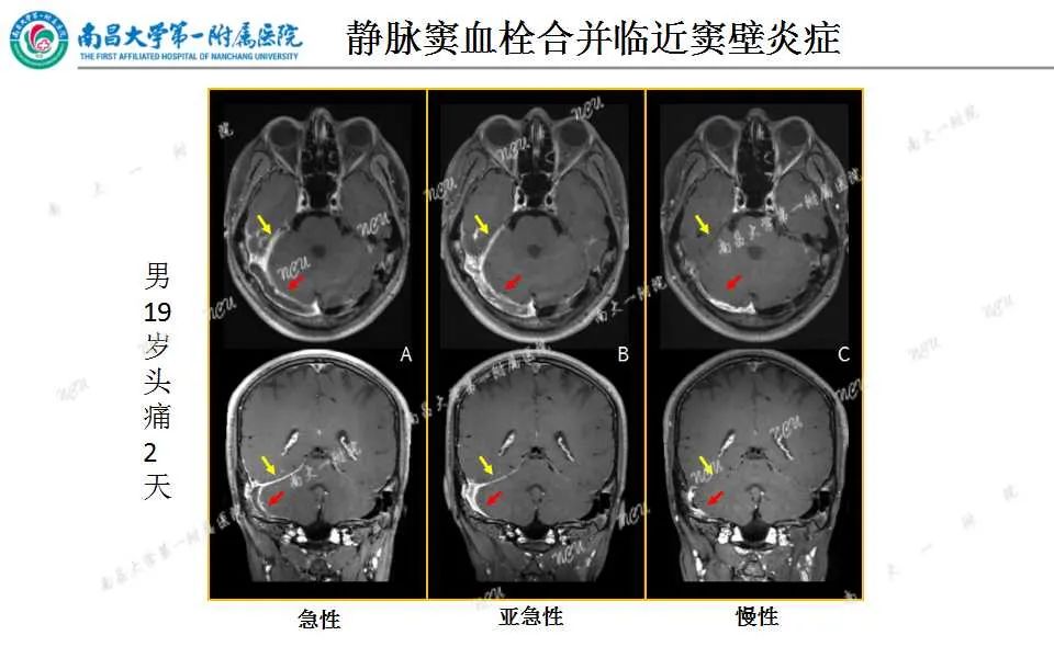 影像PPT - 【PPT】颅内静脉病变及相关卒中的影像学诊断-23
