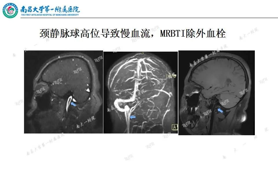 影像PPT - 【PPT】颅内静脉病变及相关卒中的影像学诊断-24