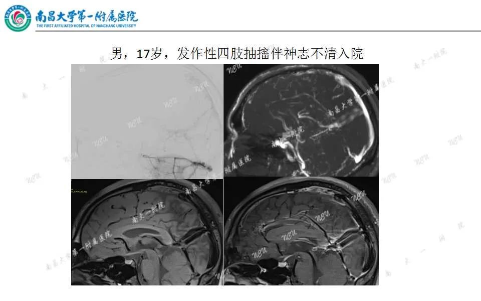 影像PPT - 【PPT】颅内静脉病变及相关卒中的影像学诊断-25
