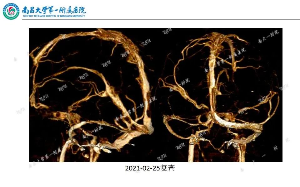影像PPT - 【PPT】颅内静脉病变及相关卒中的影像学诊断-30
