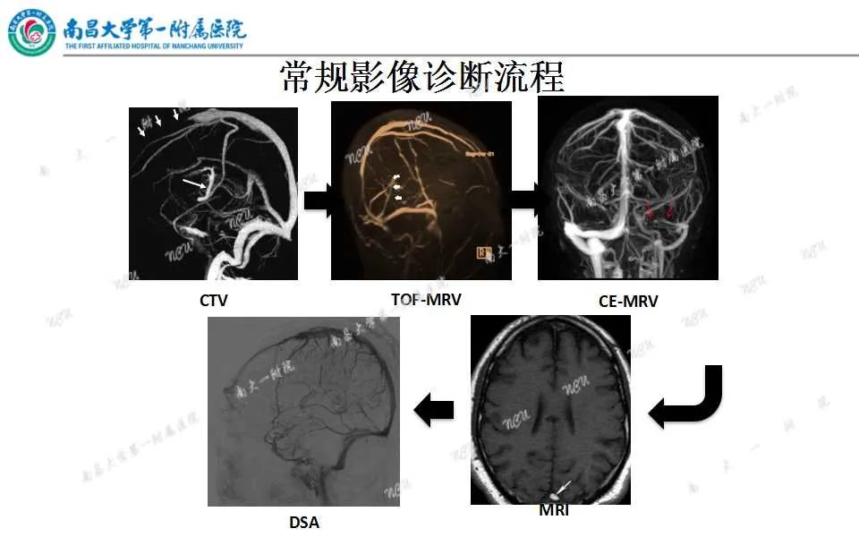 影像PPT - 【PPT】颅内静脉病变及相关卒中的影像学诊断-17