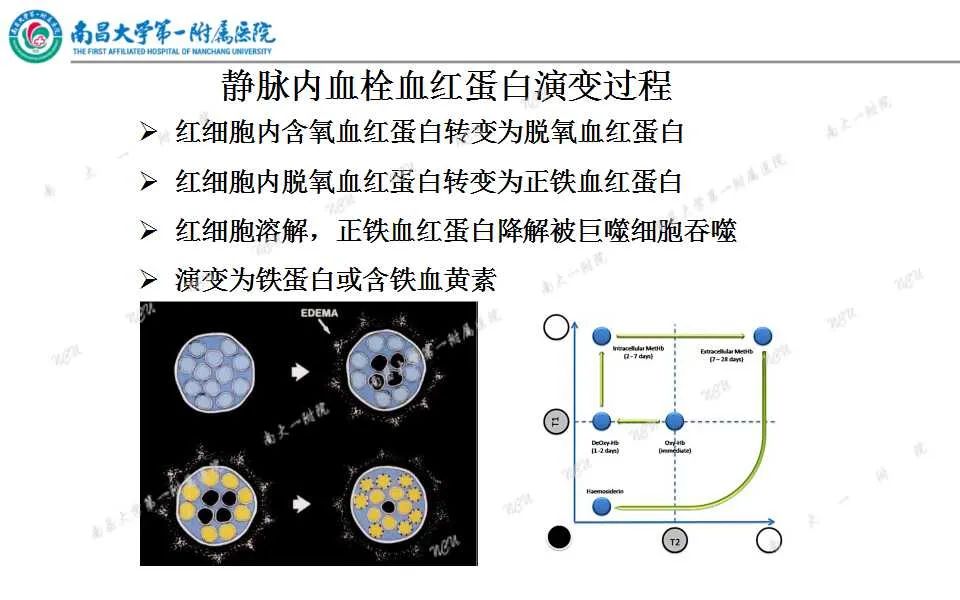 影像PPT - 【PPT】颅内静脉病变及相关卒中的影像学诊断-21
