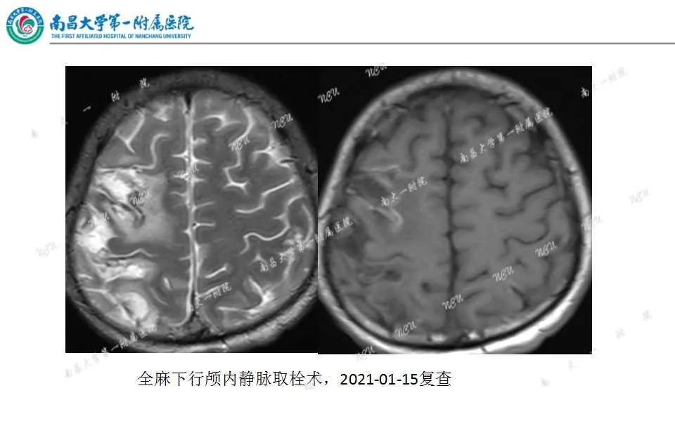 影像PPT - 【PPT】颅内静脉病变及相关卒中的影像学诊断-28