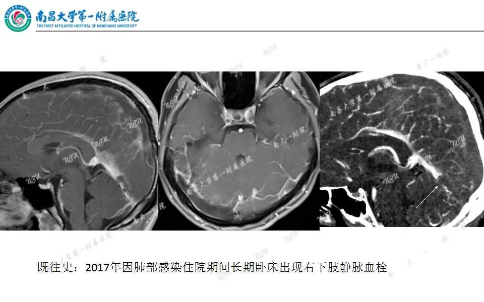 影像PPT - 【PPT】颅内静脉病变及相关卒中的影像学诊断-27