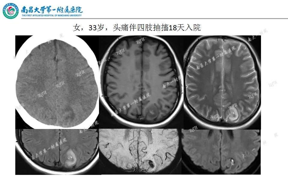 影像PPT - 【PPT】颅内静脉病变及相关卒中的影像学诊断-31