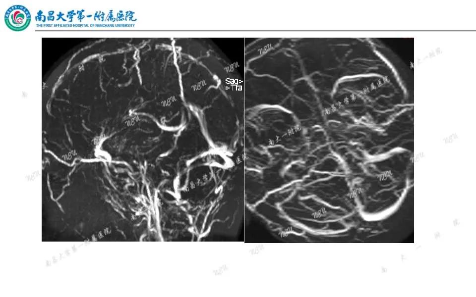 影像PPT - 【PPT】颅内静脉病变及相关卒中的影像学诊断-32