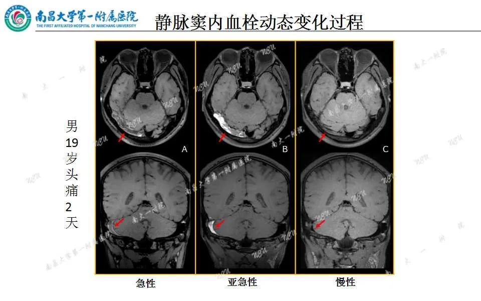影像PPT - 【PPT】颅内静脉病变及相关卒中的影像学诊断-22