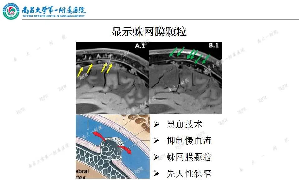 影像PPT - 【PPT】颅内静脉病变及相关卒中的影像学诊断-13