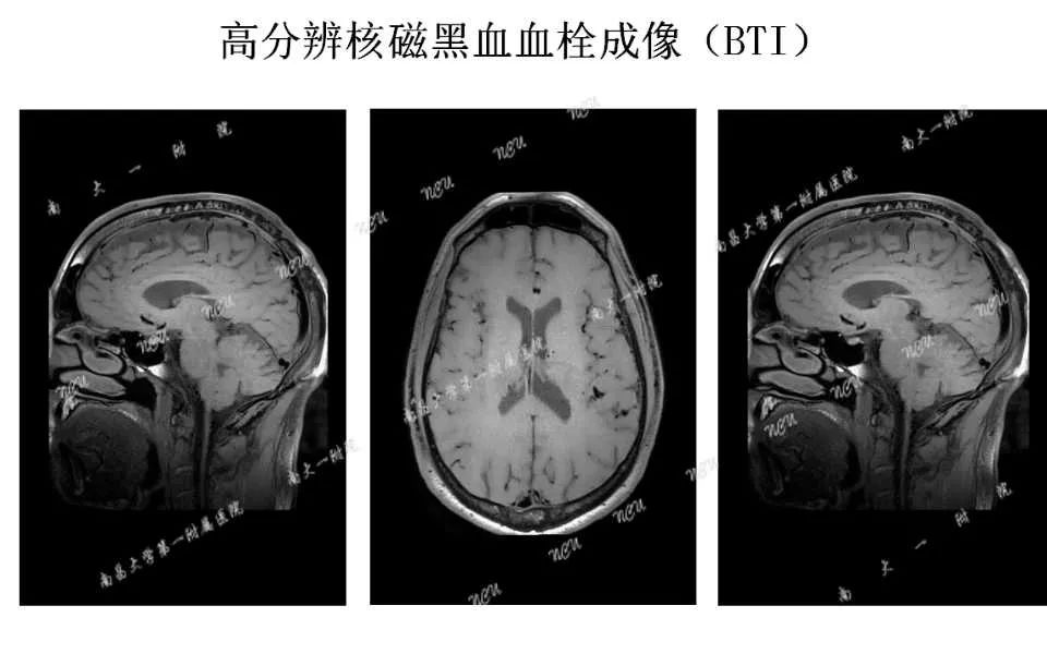 影像PPT - 【PPT】颅内静脉病变及相关卒中的影像学诊断-20
