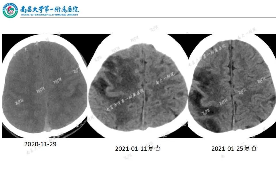 影像PPT - 【PPT】颅内静脉病变及相关卒中的影像学诊断-2