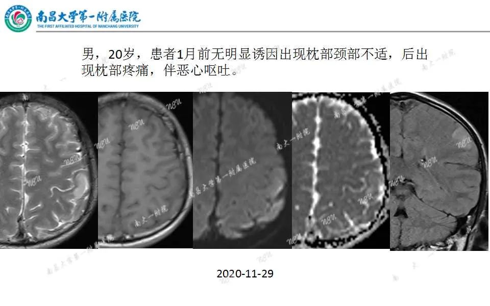 影像PPT - 【PPT】颅内静脉病变及相关卒中的影像学诊断-1