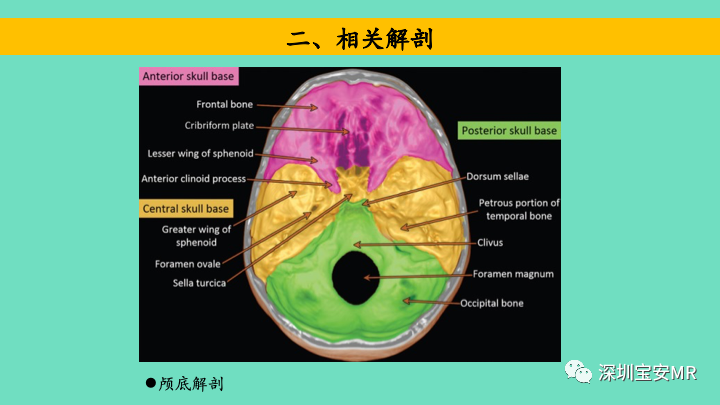 影像PPT - 【PPT】颅底骨髓炎影像诊断-4