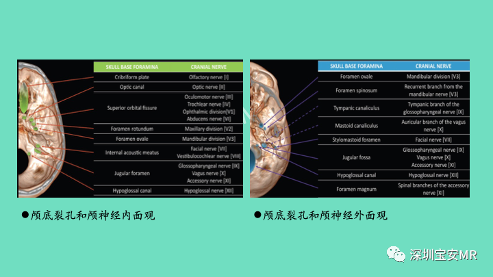 影像PPT - 【PPT】颅底骨髓炎影像诊断-5
