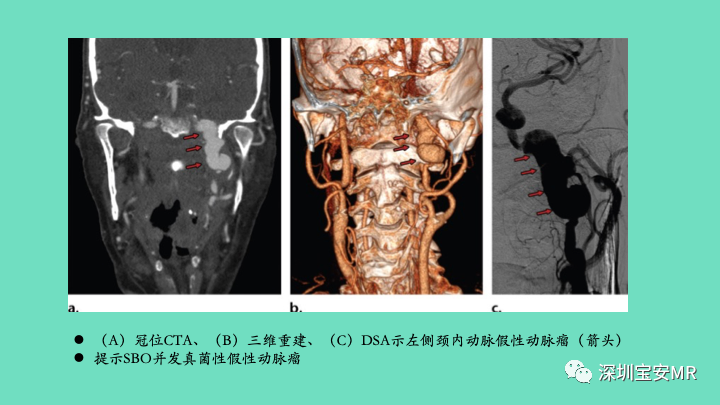 影像PPT - 【PPT】颅底骨髓炎影像诊断-11