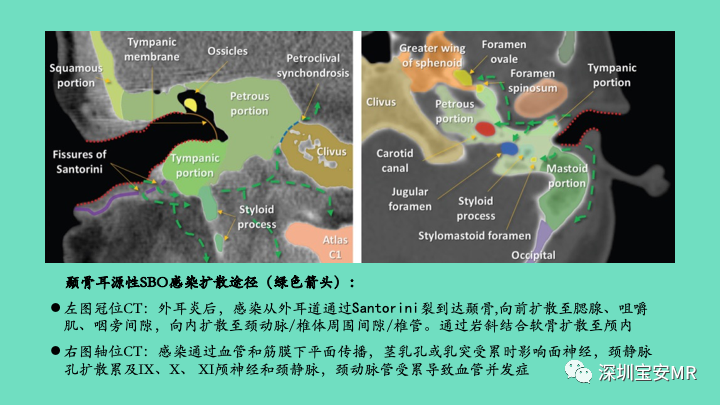 影像PPT - 【PPT】颅底骨髓炎影像诊断-6