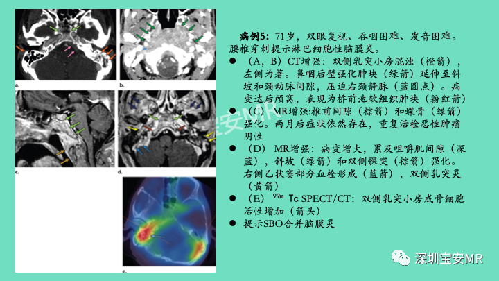 影像PPT - 【PPT】颅底骨髓炎影像诊断-15