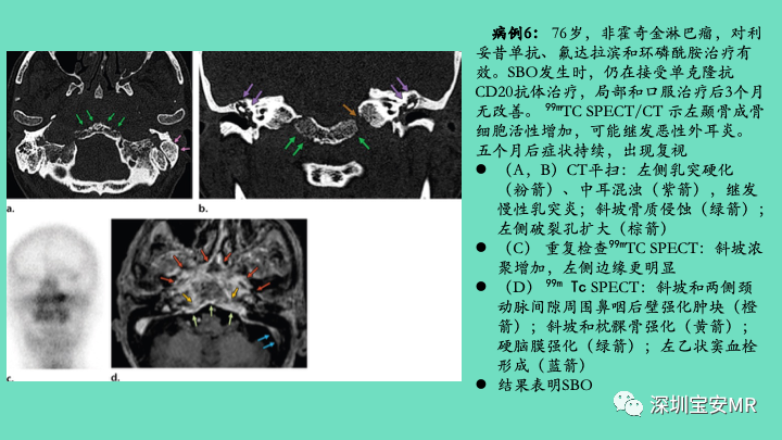 影像PPT - 【PPT】颅底骨髓炎影像诊断-16