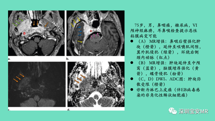 影像PPT - 【PPT】颅底骨髓炎影像诊断-19
