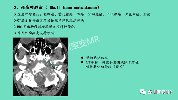 影像PPT - 【PPT】颅底骨髓炎影像诊断-20