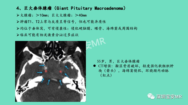 影像PPT - 【PPT】颅底骨髓炎影像诊断-22
