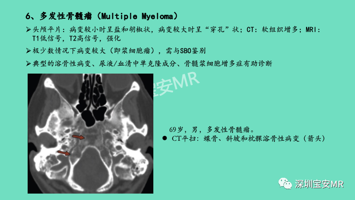 影像PPT - 【PPT】颅底骨髓炎影像诊断-24