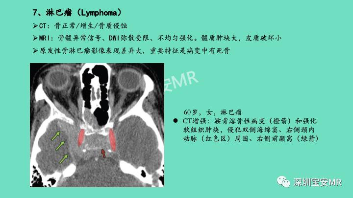 影像PPT - 【PPT】颅底骨髓炎影像诊断-25