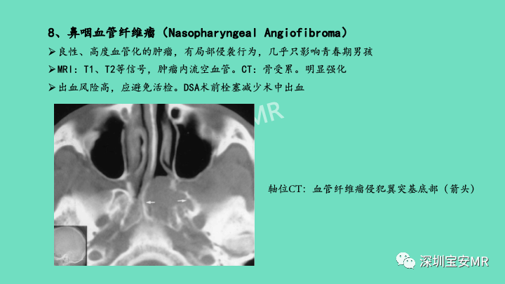 影像PPT - 【PPT】颅底骨髓炎影像诊断-26