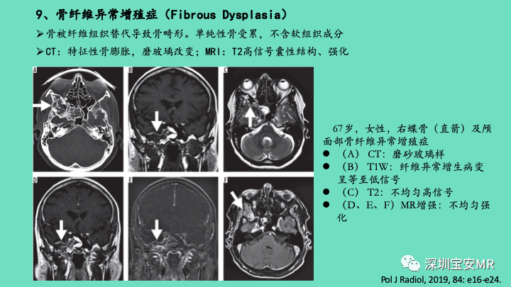 影像PPT - 【PPT】颅底骨髓炎影像诊断-27