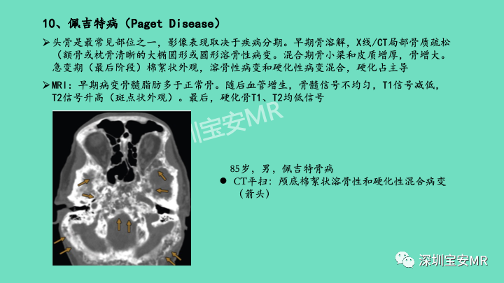 影像PPT - 【PPT】颅底骨髓炎影像诊断-28