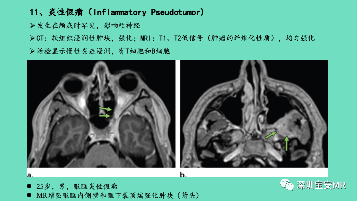 影像PPT - 【PPT】颅底骨髓炎影像诊断-29