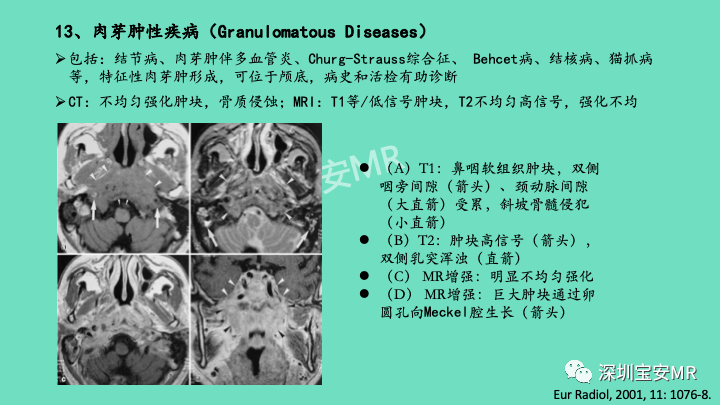 影像PPT - 【PPT】颅底骨髓炎影像诊断-31