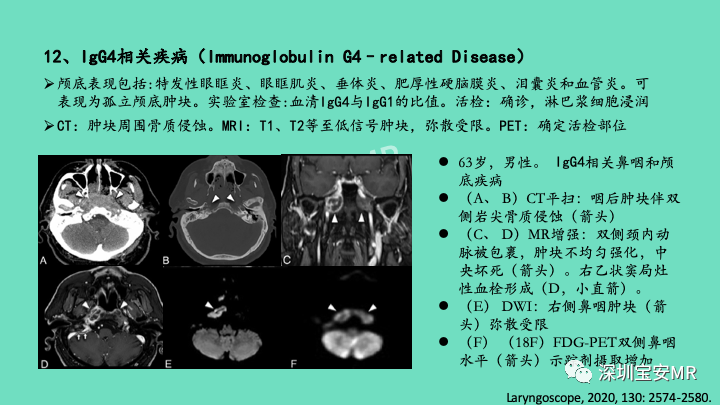 影像PPT - 【PPT】颅底骨髓炎影像诊断-30