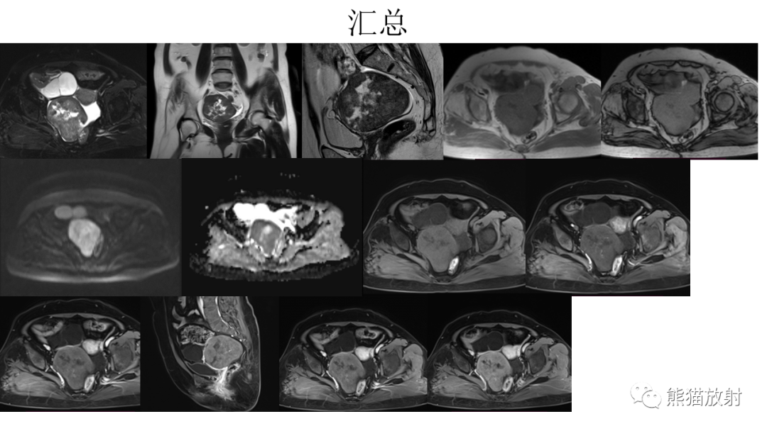 影像PPT - 【病例】卵巢卵泡膜纤维瘤2例MR影像-15