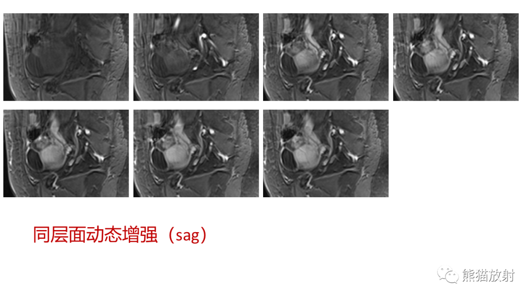 影像PPT - 【病例】卵巢卵泡膜纤维瘤2例MR影像-26