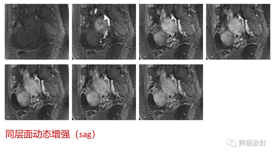 影像PPT - 【病例】卵巢卵泡膜纤维瘤2例MR影像-27