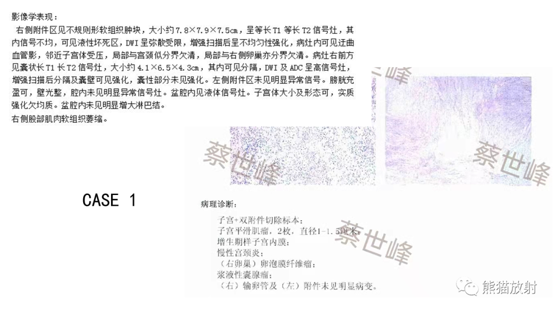 影像PPT - 【病例】卵巢卵泡膜纤维瘤2例MR影像-32