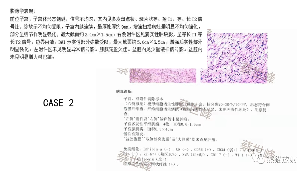 影像PPT - 【病例】卵巢卵泡膜纤维瘤2例MR影像-33