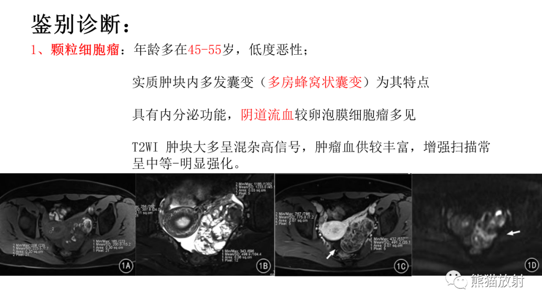 影像PPT - 【病例】卵巢卵泡膜纤维瘤2例MR影像-39