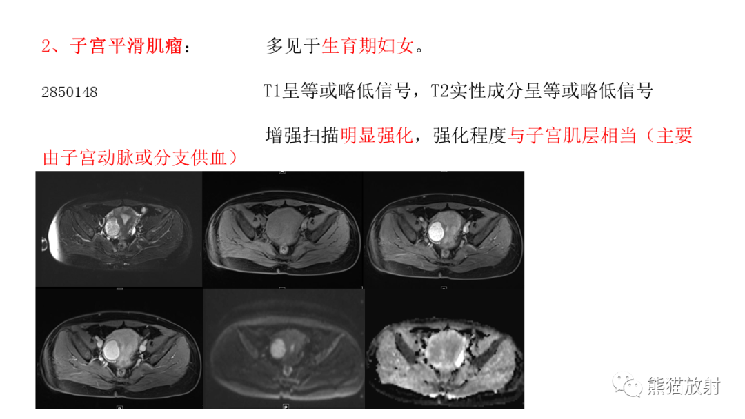 影像PPT - 【病例】卵巢卵泡膜纤维瘤2例MR影像-40